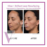 Clear and Brilliant Laser Treatment