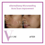 Microneedling / Mesotherapy