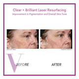 Clear and Brilliant Laser Treatment