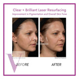 Clear and Brilliant Laser Treatment