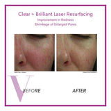 Clear and Brilliant Laser Treatment
