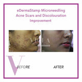 Microneedling / Mesotherapy