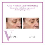 Clear and Brilliant Laser Treatment