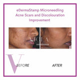 Microneedling / Mesotherapy