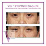Clear and Brilliant Laser Treatment
