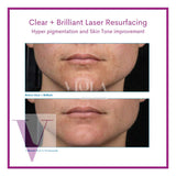 Clear and Brilliant Laser Treatment