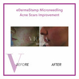 Microneedling / Mesotherapy
