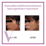 DiamondGlow (SilkPeel Dermalinfusion) Medi-Facial