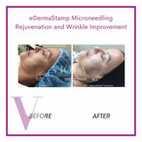Microneedling / Mesotherapy