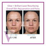 Clear and Brilliant Laser Treatment