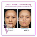 Clear and Brilliant Laser Treatment