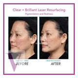 Clear and Brilliant Laser Treatment