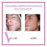 DiamondGlow (SilkPeel Dermalinfusion) Medi-Facial