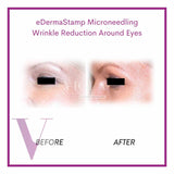 Microneedling / Mesotherapy