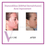 DiamondGlow (SilkPeel Dermalinfusion) Medi-Facial