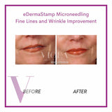 Microneedling / Mesotherapy
