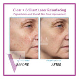 Clear and Brilliant Laser Treatment