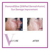DiamondGlow (SilkPeel Dermalinfusion) Medi-Facial
