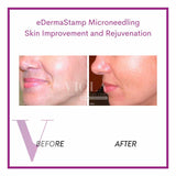 Microneedling / Mesotherapy