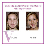 DiamondGlow (SilkPeel Dermalinfusion) Medi-Facial