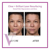 Clear and Brilliant Laser Treatment
