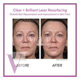 Clear and Brilliant Laser Treatment