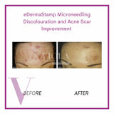 Microneedling / Mesotherapy