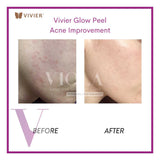 Chemical Peel