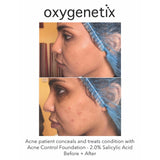 Oxygenetix Acne Control Foundation - Tawny Colour