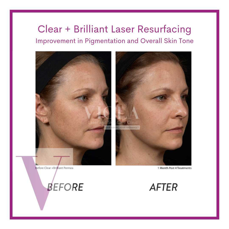 Clear and Brilliant Laser Treatment