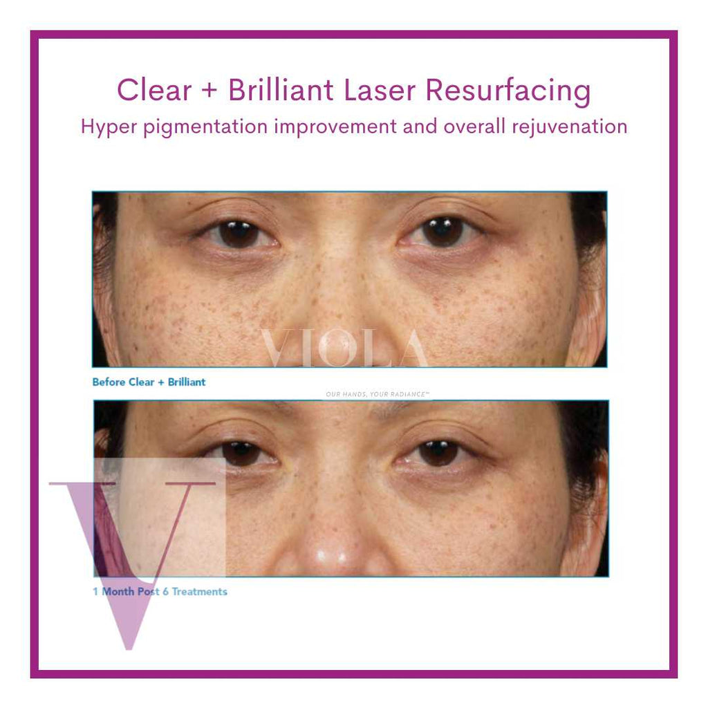Clear and Brilliant Laser Toronto | Skin Resurfacing | Viola Laser ...