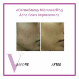 Microneedling / Mesotherapy