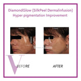DiamondGlow (SilkPeel Dermalinfusion) Medi-Facial