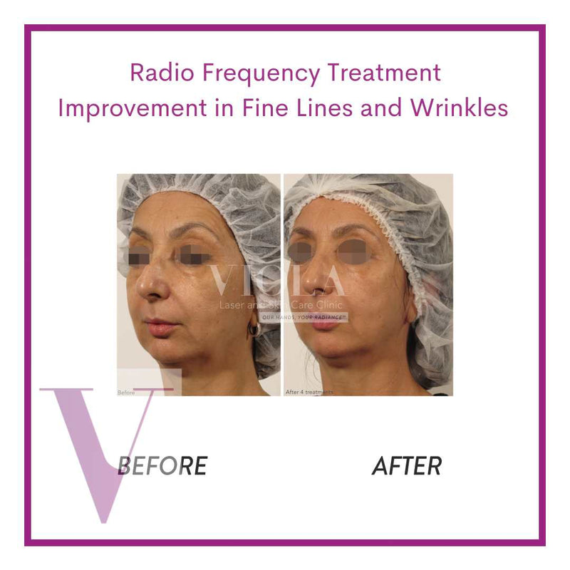 Radio Frequency Skin Tightening (Face / Neck)