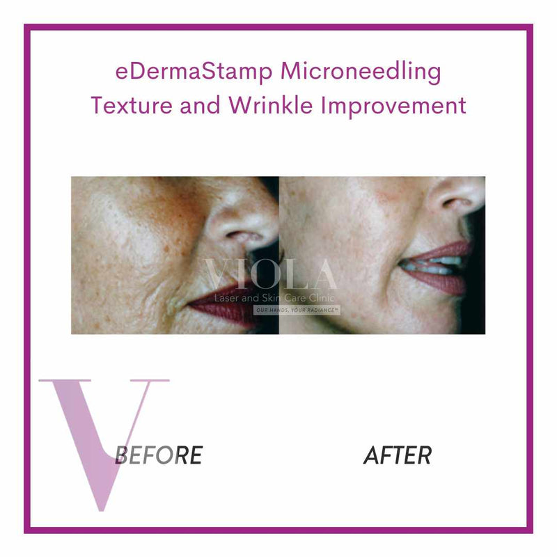 Microneedling / Mesotherapy