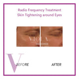 Radio Frequency Skin Tightening (Eye)