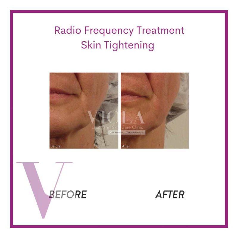 Radio Frequency Skin Tightening (Face / Neck)
