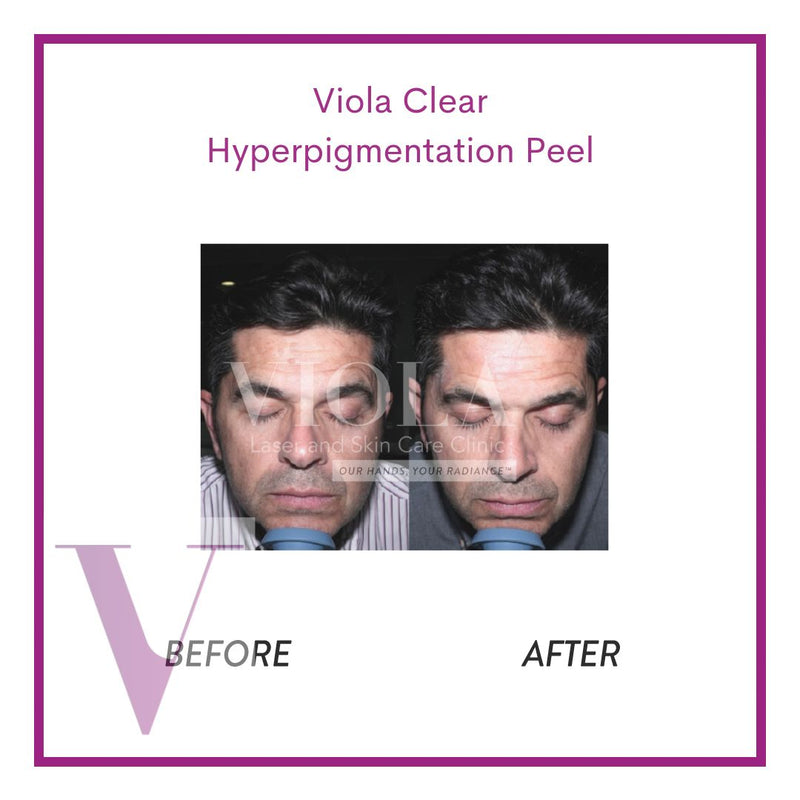 Clear by Viola - Hyperpigmentation Chemical Peel
