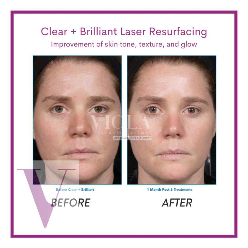 Clear and Brilliant Laser Treatment