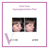 Clear by Viola - Hyperpigmentation Chemical Peel