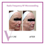 RF (Radio Frequency) Microneedling