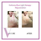Celluma POD (LED Light Therapy to Improve Skin, Acne , and Pain)