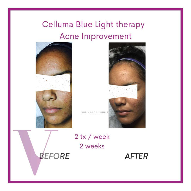 Celluma POD (LED Light Therapy to Improve Skin, Acne , and Pain)